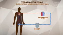 mc-marcinho-usa-terapia-conhecida-como-ecmo,-especie-de-pulmao-artificial;-entenda-como-funciona